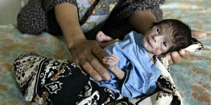 iraq_sanctions_malnutrition_460